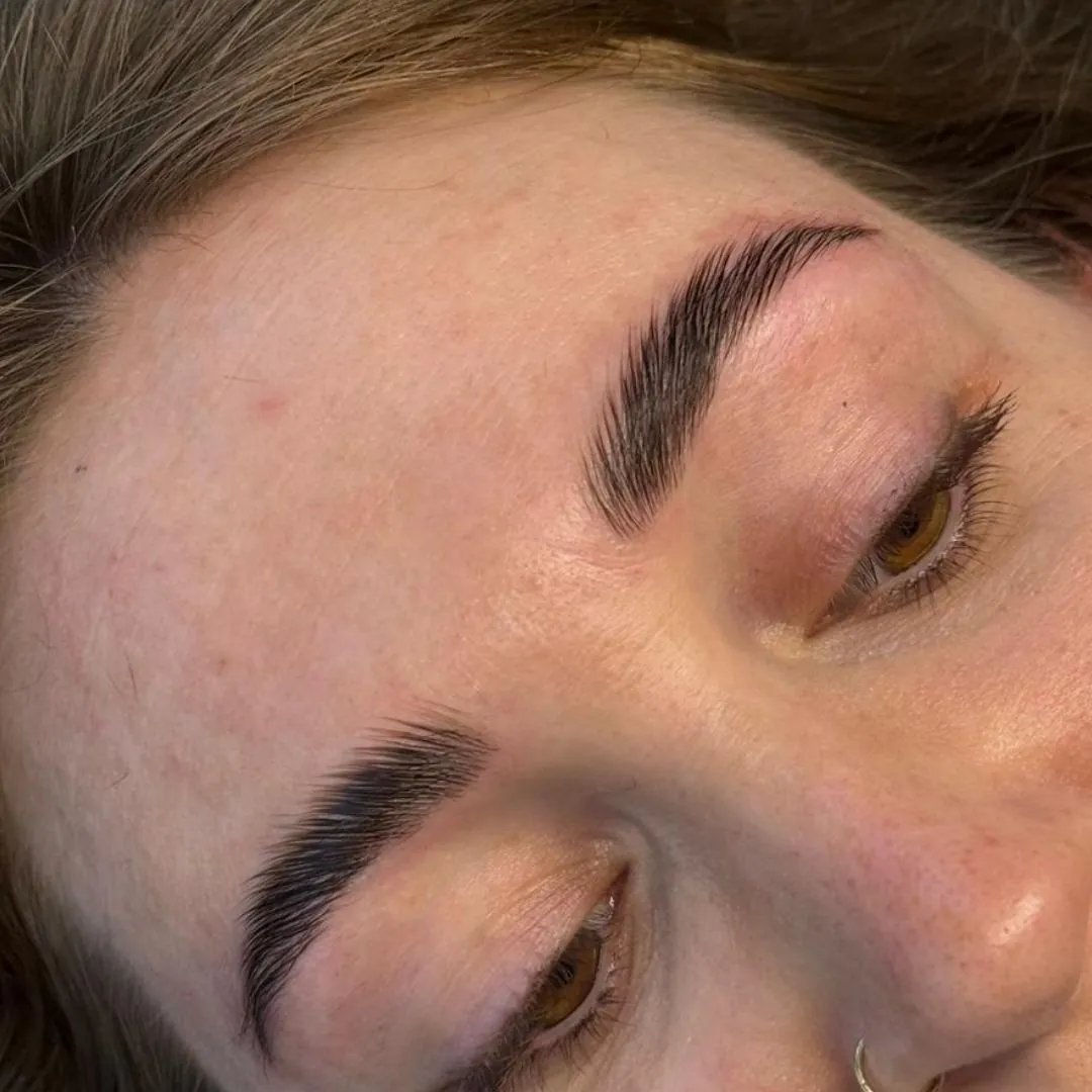 Ergebnis eines Brow Liftings, Nahaufnahme