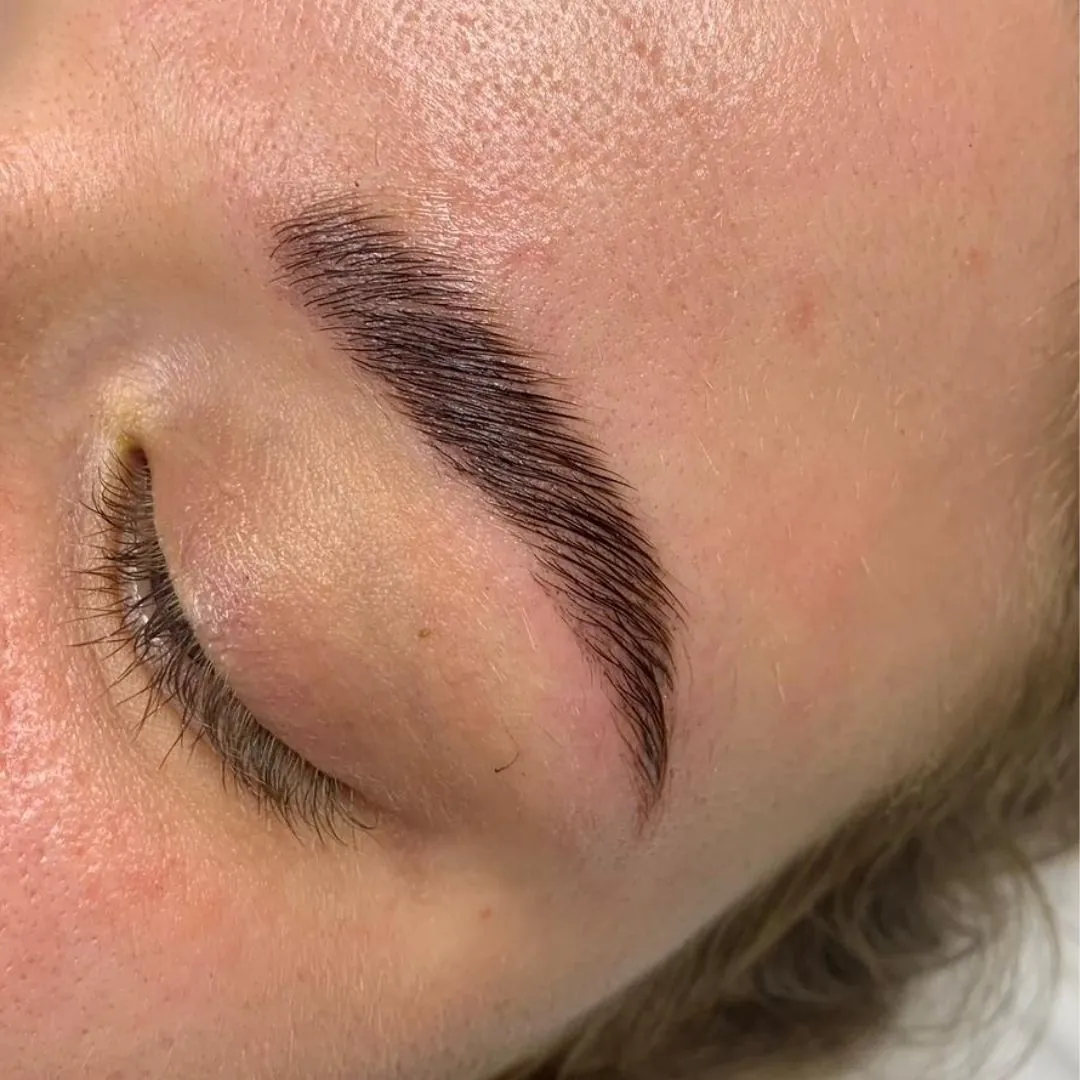 Ergebnis eines Brow Liftings, Nahaufnahme