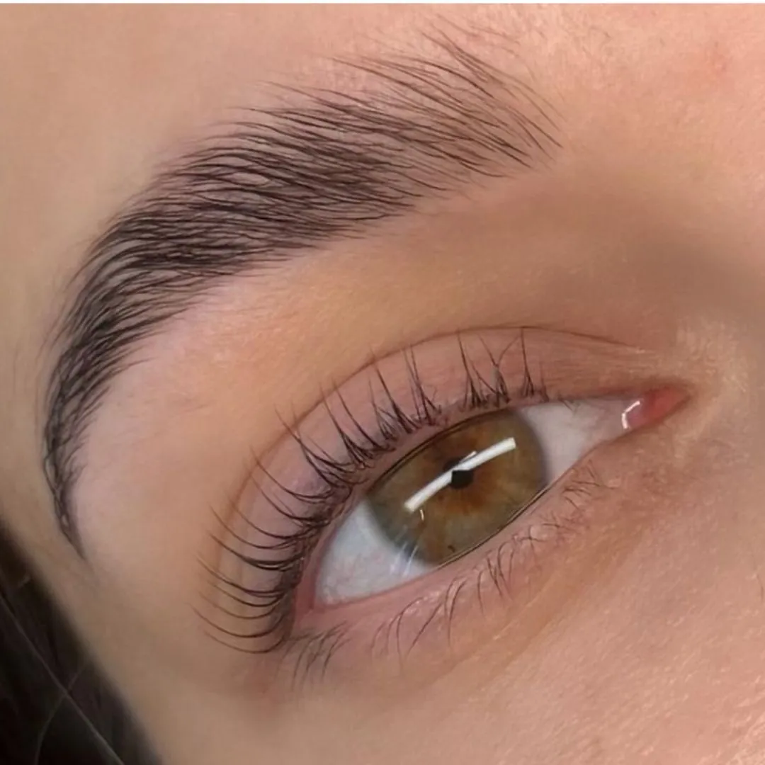 Ergebnis eines Brow Liftings, Nahaufnahme