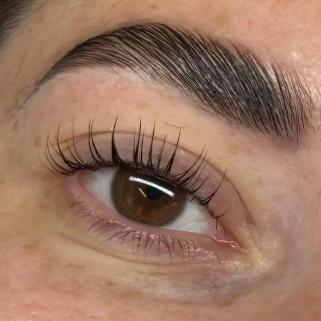 Ergebnis eines Brow Liftings, Nahaufnahme