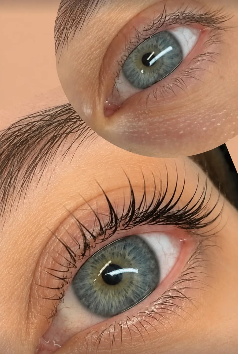 Ergebnis eines Brow Liftings